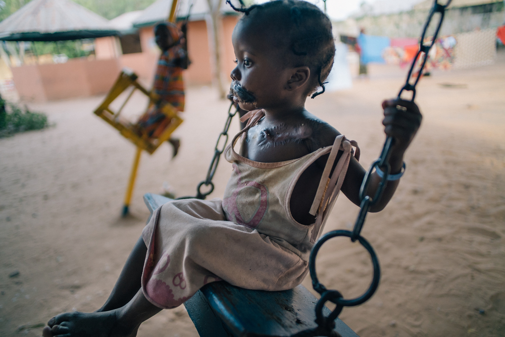 Die vierjährige Maryam wurde aufgrund ihrer Noma-Erkrankung im Krankenhaus in Sokoto operiert